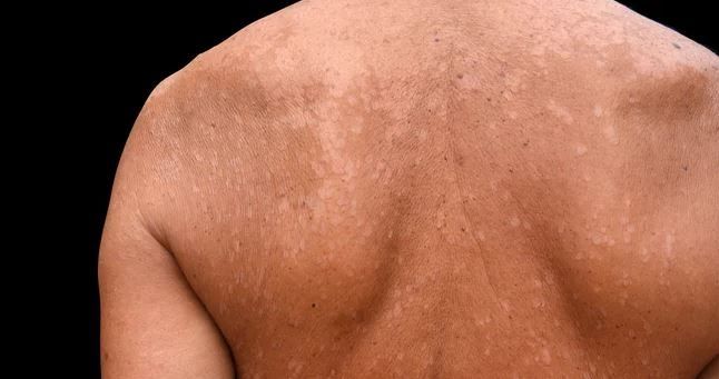 5 Obat untuk Mengatasi Panu agar Cepat Hilang
