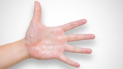 5 Penyebab Telapak Tangan Berkeringat
